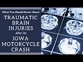 FightingForFairness.com - Motorcycle riders are far more like to suffer a traumatic brain injury (TBI) during an Iowa bike accident. This video addresses the symptoms of TBI, recovering after a...